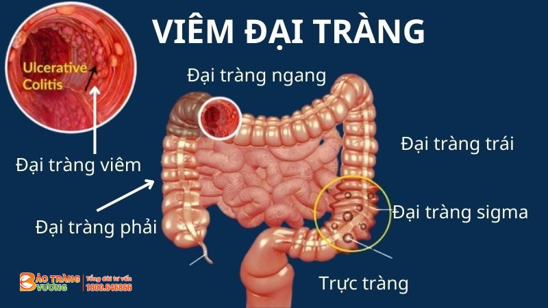 Viêm đại tràng là bệnh lý đường tiêu hóa thường gặp ở Việt Nam