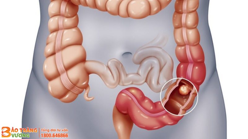 Ung thư đại tràng là bệnh lý phổ biến dễ gặp