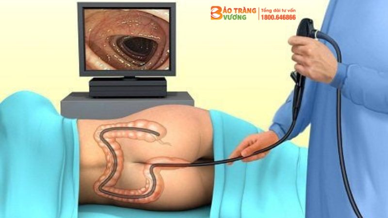 Hình ảnh minh họa nội soi đại tràng
