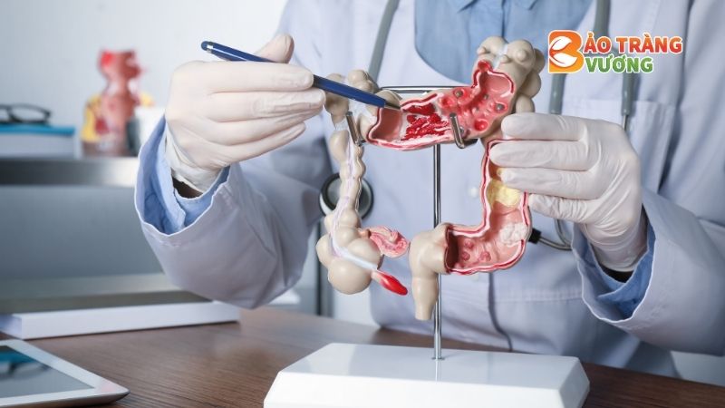 Hội chứng ruột kích thích (IBS - Irritable Bowel Syndrome) là một rối loạn tiêu hóa mạn tính